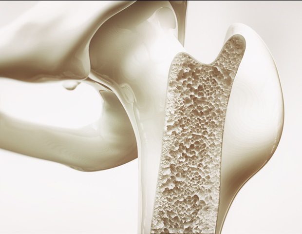 1753357192 Osteoporosis stage 3 of 4 upper limb bones 3d rendering Crevis M1 62ee9a3e223b497ca6798e45d894de93