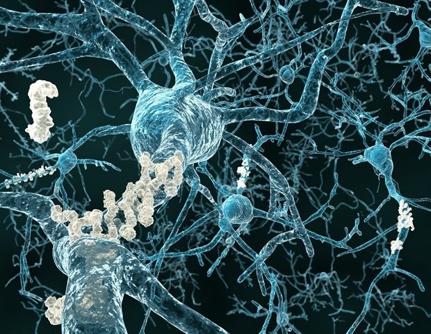 Alzheimers amyloid plaque Juan Gaertner 9638f1223d534b518a192c8478871d65