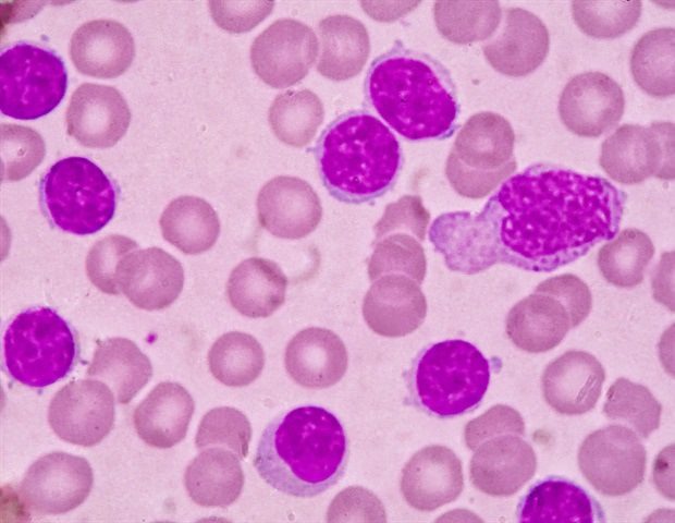 Blood smear under microscopy showing chronic lymphoblastic leukemia CLL Medtech THAI STUDIO LAB 249 5668a625a9ad46978c78f22fdb7af040