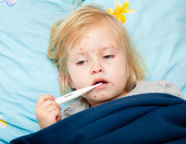 Measles